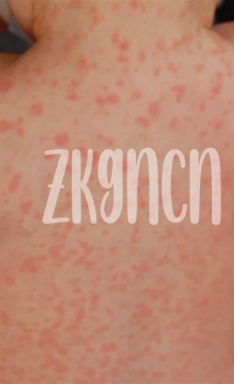 Természetes Módszerek Amoxicillin Rash Enyhítésére